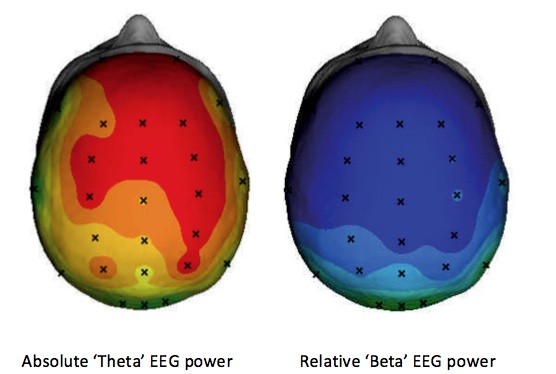 brain activity increased theta EEG power in ADHD