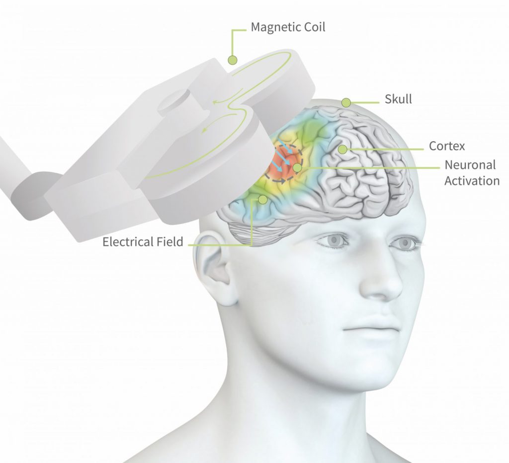 rTMS: repetitive transcranial magnetic stimulation and depression - Braincl...