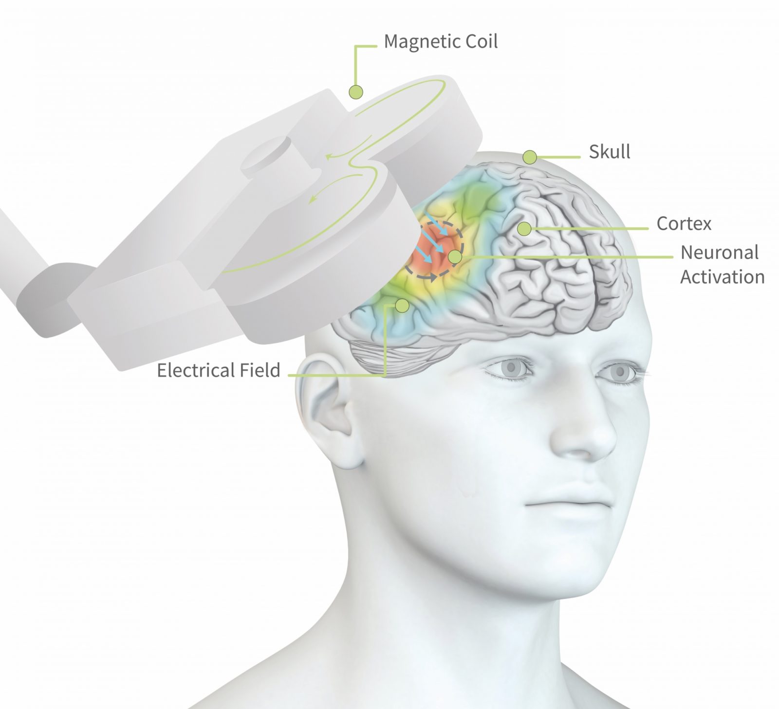 Rtms Repetitive Transcranial Magnetic